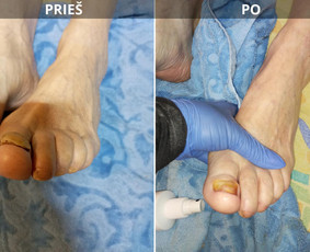 Probleminių nagų, padų, nuospaudų,varkymas jūsų namuose / Aida / Darbų pavyzdys ID 3779037