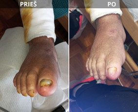 Probleminių nagų, padų, nuospaudų,varkymas jūsų namuose / Aida / Darbų pavyzdys ID 3780135