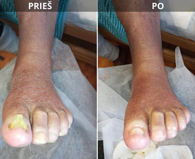 Probleminių nagų, padų, nuospaudų,varkymas jūsų namuose / Aida / Darbų pavyzdys ID 3780137