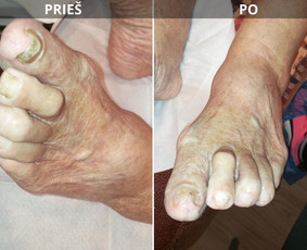 Probleminių nagų, padų, nuospaudų,varkymas jūsų namuose / Aida / Darbų pavyzdys ID 3793046
