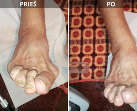 Probleminių nagų, padų, nuospaudų,varkymas jūsų namuose / Aida / Darbų pavyzdys ID 3793048