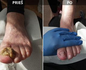 Probleminių nagų, padų, nuospaudų,varkymas jūsų namuose / Aida / Darbų pavyzdys ID 3813084