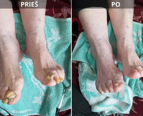Probleminių nagų, padų, nuospaudų,varkymas jūsų namuose / Aida / Darbų pavyzdys ID 3830229