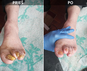 Probleminių nagų, padų, nuospaudų,varkymas jūsų namuose / Aida / Darbų pavyzdys ID 3830231