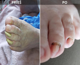 Probleminių nagų, padų, nuospaudų,varkymas jūsų namuose / Aida / Darbų pavyzdys ID 3897804