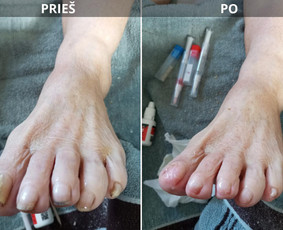 Probleminių nagų, padų, nuospaudų,varkymas jūsų namuose / Aida / Darbų pavyzdys ID 3897808