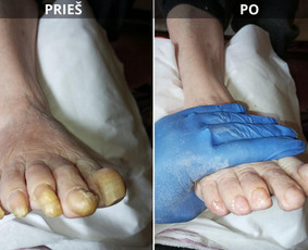 Probleminių nagų, padų, nuospaudų,varkymas jūsų namuose / Aida / Darbų pavyzdys ID 3918906