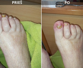 Probleminių nagų, padų, nuospaudų,varkymas jūsų namuose / Aida / Darbų pavyzdys ID 3918912