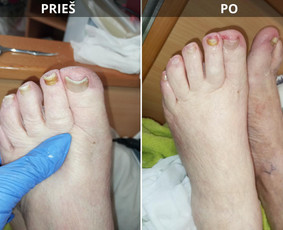 Probleminių nagų, padų, nuospaudų,varkymas jūsų namuose / Aida / Darbų pavyzdys ID 3918914