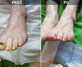 Probleminių nagų, padų, nuospaudų,varkymas jūsų namuose / Aida / Darbų pavyzdys ID 3941472