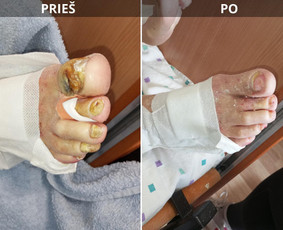 Probleminių nagų, padų, nuospaudų,varkymas jūsų namuose / Aida / Darbų pavyzdys ID 3941474