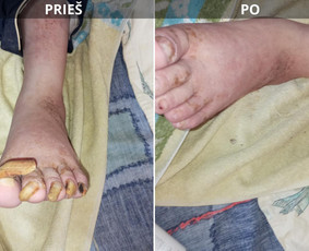 Probleminių nagų, padų, nuospaudų,varkymas jūsų namuose / Aida / Darbų pavyzdys ID 3949956