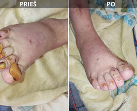 Probleminių nagų, padų, nuospaudų,varkymas jūsų namuose / Aida / Darbų pavyzdys ID 3949958