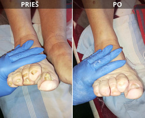 Probleminių nagų, padų, nuospaudų,varkymas jūsų namuose / Aida / Darbų pavyzdys ID 3971827