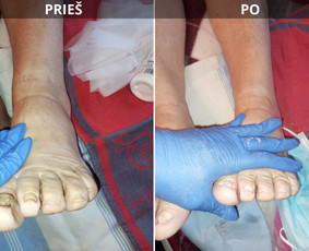 Probleminių nagų, padų, nuospaudų,varkymas jūsų namuose / Aida / Darbų pavyzdys ID 3971829