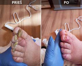 Probleminių nagų, padų, nuospaudų,varkymas jūsų namuose / Aida / Darbų pavyzdys ID 3971831