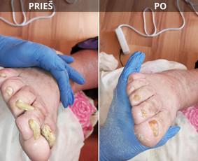 Probleminių nagų, padų, nuospaudų,varkymas jūsų namuose / Aida / Darbų pavyzdys ID 3971833