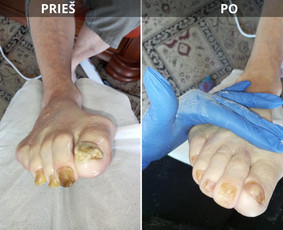Probleminių nagų, padų, nuospaudų,varkymas jūsų namuose / Aida / Darbų pavyzdys ID 3991337