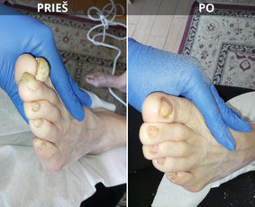 Probleminių nagų, padų, nuospaudų,varkymas jūsų namuose / Aida / Darbų pavyzdys ID 3991343