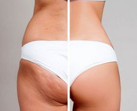 Масаж - Anticeliulitinis masažas - 1 Anticeliulitinis masažas - Масаж - 1