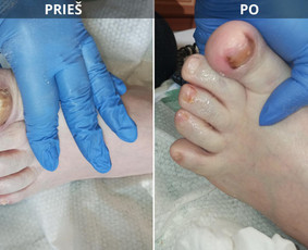 Probleminių nagų, padų, nuospaudų,varkymas jūsų namuose / Aida / Darbų pavyzdys ID 4063243