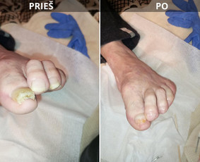 Probleminių nagų, padų, nuospaudų,varkymas jūsų namuose / Aida / Darbų pavyzdys ID 4063245