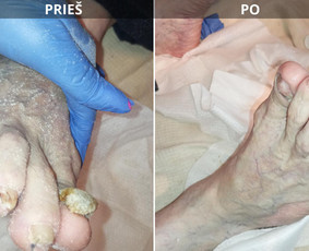Probleminių nagų, padų, nuospaudų,varkymas jūsų namuose / Aida / Darbų pavyzdys ID 4063247