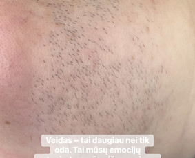 Elektroepiliacija Šiauliuose - Kosmetologės - 2 Kosmetologės - Elektroepiliacija Šiauliuose - 2