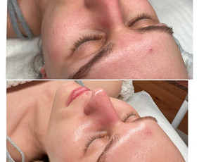 Veido Masažai Japoniškas Kobido Spa veido procedūros - Ultragarsinis veido valymas - 3 Ultragarsinis veido valymas - Veido Masažai Japoniškas Kobido Spa veido procedūros - 3