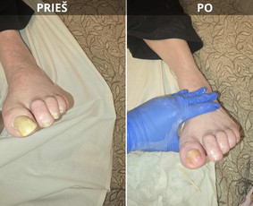 Probleminių nagų, padų, nuospaudų,varkymas jūsų namuose / Aida / Darbų pavyzdys ID 4080733