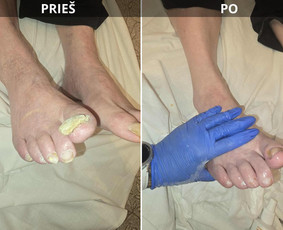 Probleminių nagų, padų, nuospaudų,varkymas jūsų namuose / Aida / Darbų pavyzdys ID 4080735