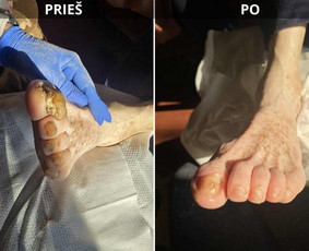 Probleminių nagų, padų, nuospaudų,varkymas jūsų namuose / Aida / Darbų pavyzdys ID 4080739