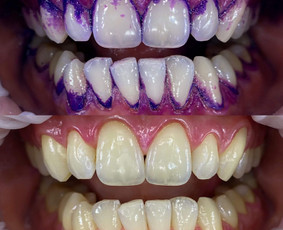 Profesionali burnos higiena - About Smile odontologijos klinika Vilniuje - 1