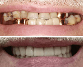 About Smile odontologijos klinika Vilniuje - Dantų balinimas - 3 Dantų balinimas - About Smile odontologijos klinika Vilniuje - 3