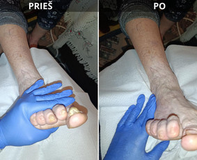 Probleminių nagų, padų, nuospaudų,varkymas jūsų namuose / Aida / Darbų pavyzdys ID 4140244