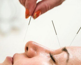 Sveikata, gydymas - Akupunktūra - 4