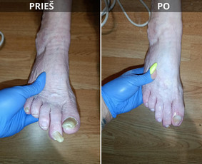 Probleminių nagų, padų, nuospaudų,varkymas jūsų namuose / Aida / Darbų pavyzdys ID 4150770