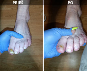 Probleminių nagų, padų, nuospaudų,varkymas jūsų namuose / Aida / Darbų pavyzdys ID 4150786
