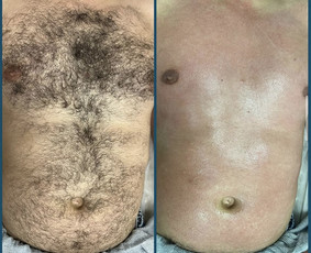 Depiliacija vašku - Depiliacija vašku vyrams ir moterims - 3