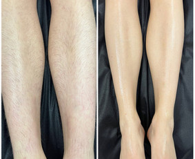 Depiliacija vašku - Depiliacija vašku vyrams ir moterims - 4