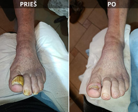 Manikiūras - Probleminių nagų bei padų tvarkymas jūsų namuose - 2