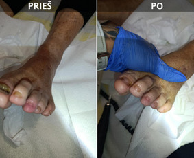 Manikiūras - Probleminių nagų bei padų tvarkymas jūsų namuose - 1