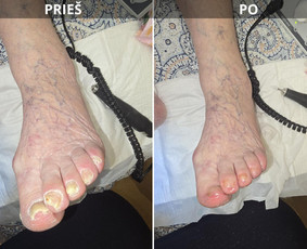 Probleminių nagų, padų, nuospaudų,varkymas jūsų namuose / Aida / Darbų pavyzdys ID 4193439