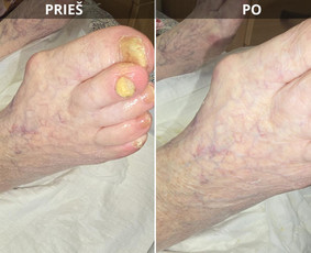 Probleminių nagų, padų, nuospaudų,varkymas jūsų namuose / Aida / Darbų pavyzdys ID 4193441