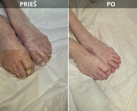 Probleminių nagų, padų, nuospaudų,varkymas jūsų namuose / Aida / Darbų pavyzdys ID 4193483