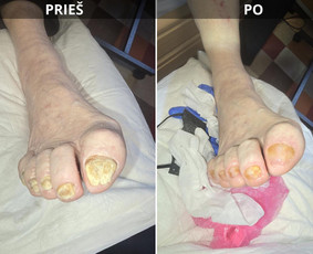 Probleminių nagų, padų, nuospaudų,varkymas jūsų namuose / Aida / Darbų pavyzdys ID 4193505