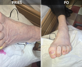 Probleminių nagų, padų, nuospaudų,varkymas jūsų namuose / Aida / Darbų pavyzdys ID 4193521