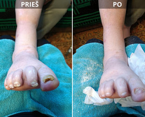 Probleminių nagų, padų, nuospaudų,varkymas jūsų namuose / Aida / Darbų pavyzdys ID 4267893