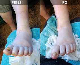 Probleminių nagų, padų, nuospaudų,varkymas jūsų namuose / Aida / Darbų pavyzdys ID 4267895