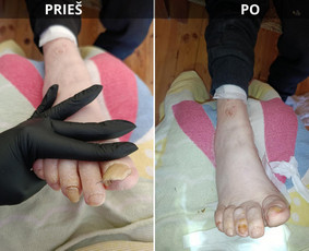 Probleminių nagų, padų, nuospaudų,varkymas jūsų namuose / Aida / Darbų pavyzdys ID 4267897